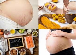 Sự thật về vết rạn da khi mang thai và cách chữa trị hiệu quả tại XUÂN TRƯỜNG